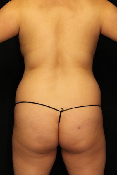 Brazilian Butt Lift Before & After Gallery - Patient 265117 - Image 1