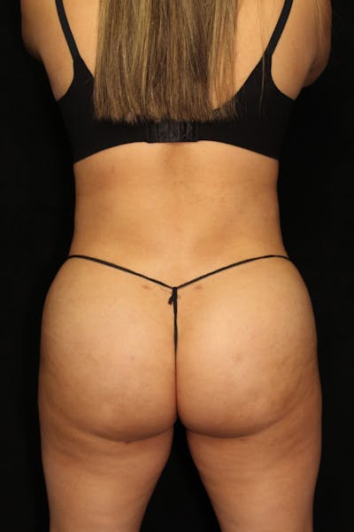 Brazilian Butt Lift Before & After Gallery - Patient 265117 - Image 2