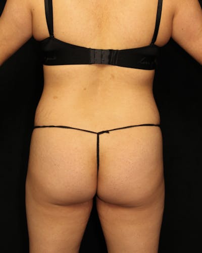 Brazilian Butt Lift Before & After Gallery - Patient 125315 - Image 1