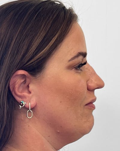 Rhinoplasty Before & After Gallery - Patient 222207 - Image 1