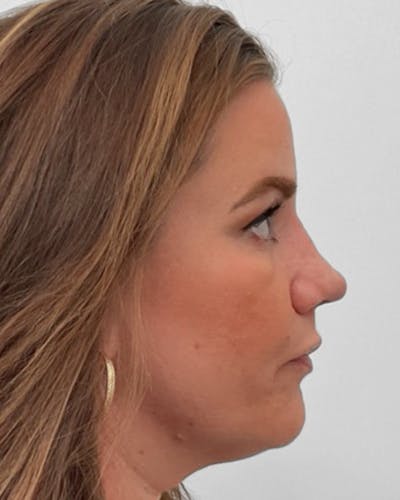 Rhinoplasty Before & After Gallery - Patient 222207 - Image 2