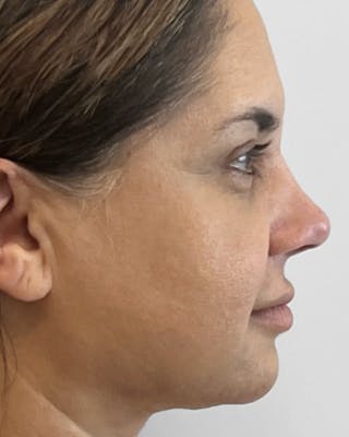 Rhinoplasty Before & After Gallery - Patient 346137 - Image 2