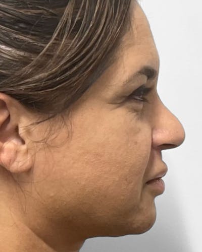 Rhinoplasty Before & After Gallery - Patient 346137 - Image 1