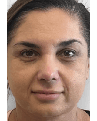 Rhinoplasty Before & After Gallery - Patient 346137 - Image 4