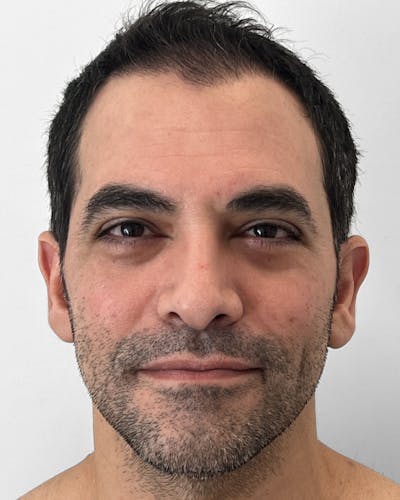 Blepharoplasty Before & After Gallery - Patient 357079 - Image 2