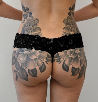 Brazilian Butt Lift Before & After Gallery - Patient 195566 - Image 4