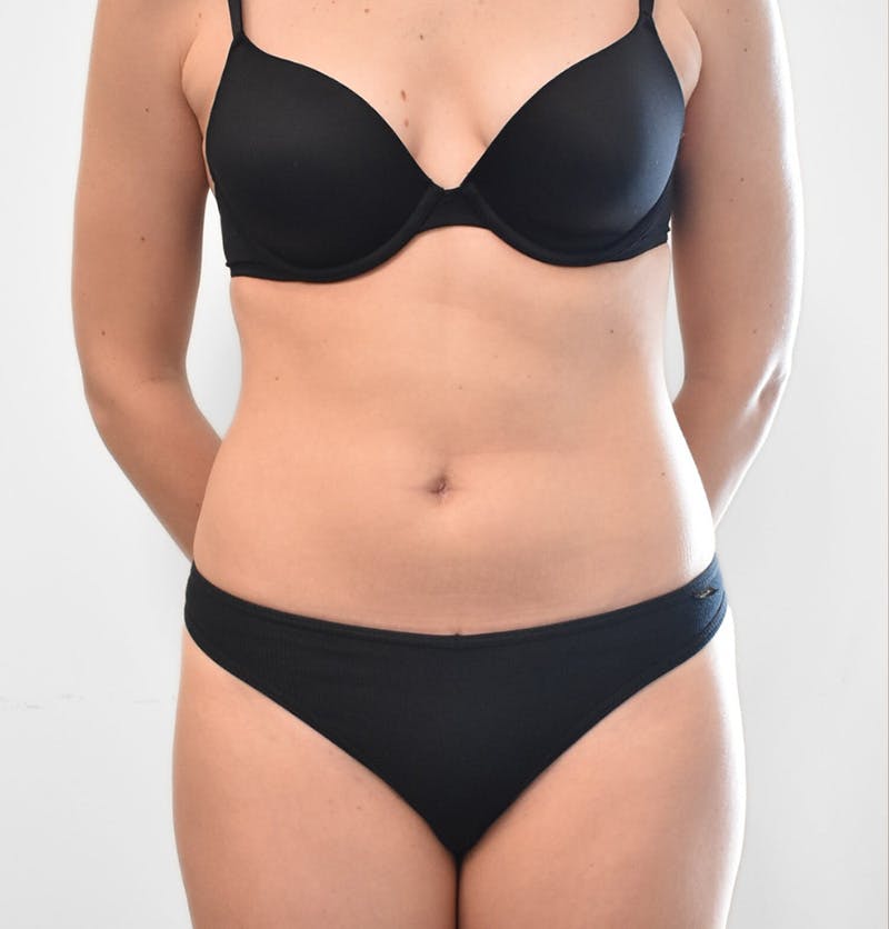 Brazilian Butt Lift Before & After Gallery - Patient 367158 - Image 3