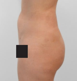 Brazilian Butt Lift Before & After Gallery - Patient 367158 - Image 2