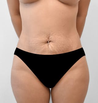 Mommy Makeover Before & After Gallery - Patient 301855 - Image 2