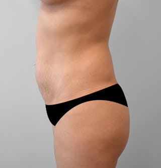 Mommy Makeover Before & After Gallery - Patient 301855 - Image 4