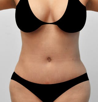 Brazilian Butt Lift Before & After Gallery - Patient 346778 - Image 4