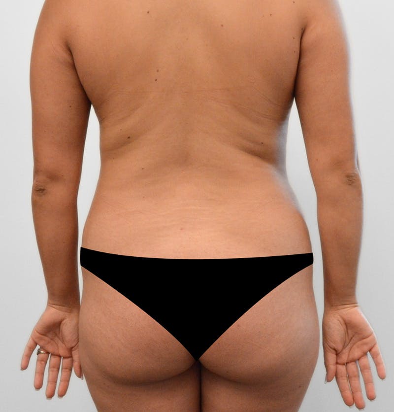 Mommy Makeover Before & After Gallery - Patient 378799 - Image 3