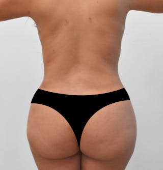 Brazilian Butt Lift Before & After Gallery - Patient 346778 - Image 2