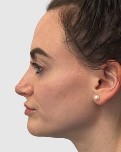 Rhinoplasty Before & After Gallery - Patient 427624 - Image 1