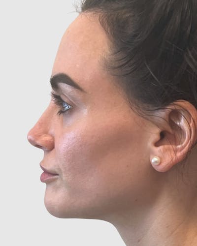 Rhinoplasty Before & After Gallery - Patient 427624 - Image 2