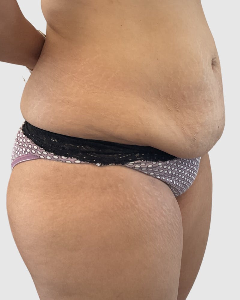 Tummy Tuck Before & After Gallery - Patient 255470 - Image 4