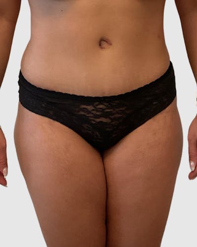 Tummy Tuck Before & After Gallery - Patient 255470 - Image 2