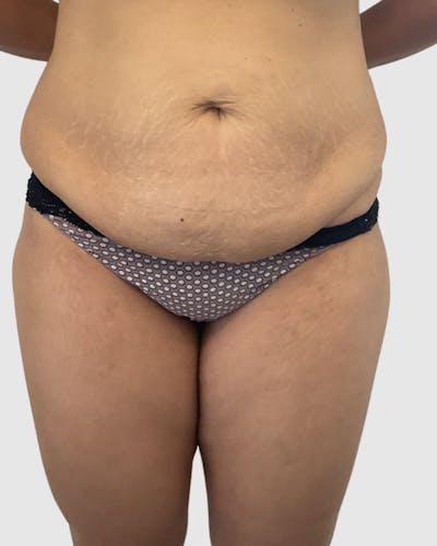 Tummy Tuck Before & After Gallery - Patient 255470 - Image 1