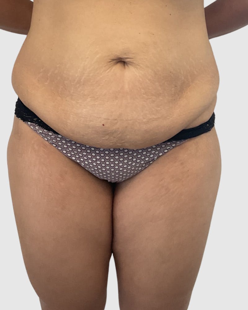 Tummy Tuck Before & After Gallery - Patient 255470 - Image 1