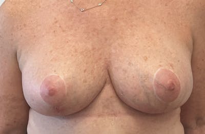 Breast Lift Before & After Gallery - Patient 191404827 - Image 2