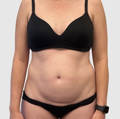 Liposuction Before & After Gallery - Patient 547386 - Image 1