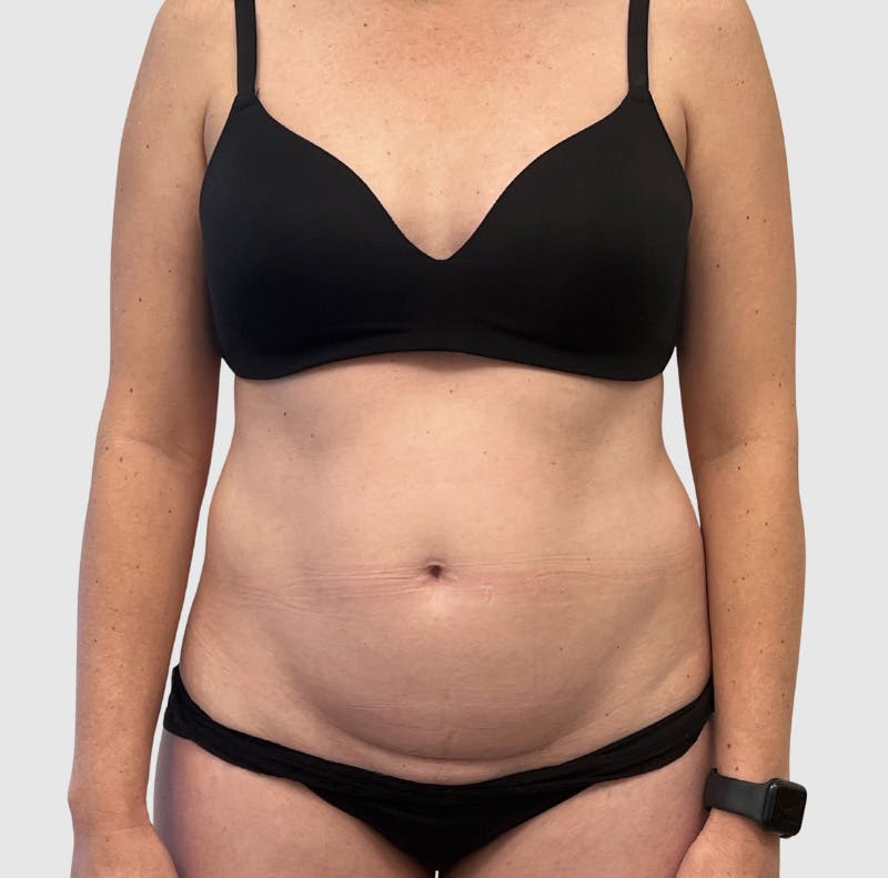Liposuction Before & After Gallery - Patient 547386 - Image 1