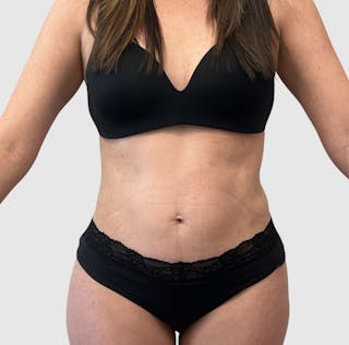 Liposuction Before & After Gallery - Patient 547386 - Image 2