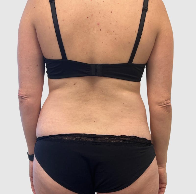 Liposuction Before & After Gallery - Patient 547386 - Image 3