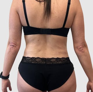 Liposuction Before & After Gallery - Patient 547386 - Image 4