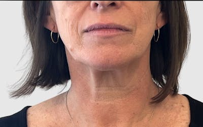 Face and Neck Lifts Before & After Gallery - Patient 191405047 - Image 1