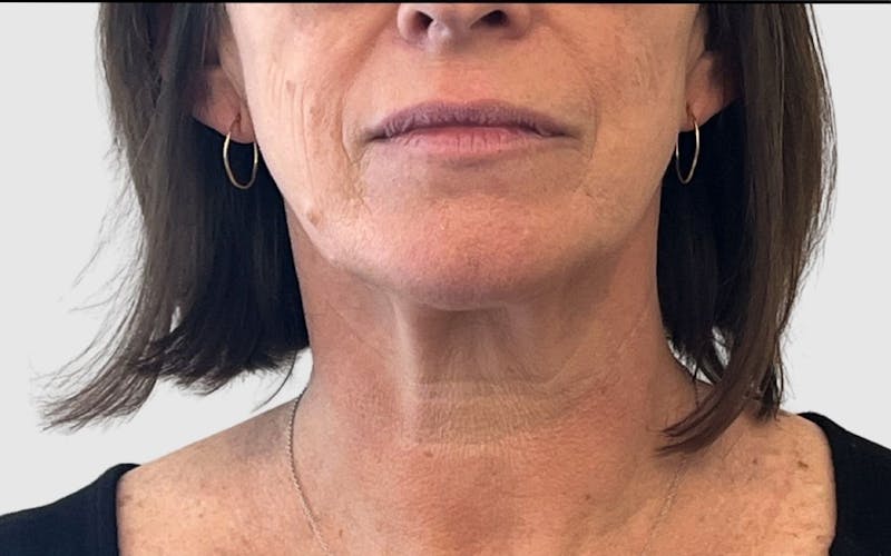 Face and Neck Lifts Before & After Gallery - Patient 191405047 - Image 1