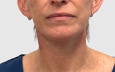 Face and Neck Lifts Before & After Gallery - Patient 191405047 - Image 2