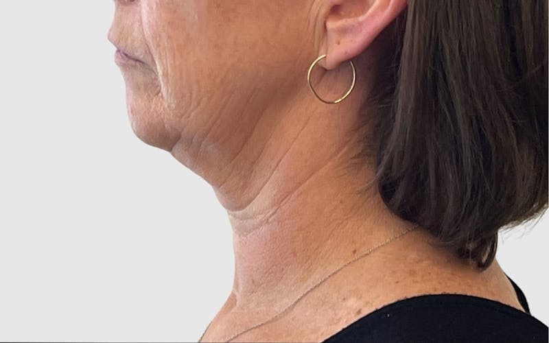 Face and Neck Lifts Before & After Gallery - Patient 191405047 - Image 3