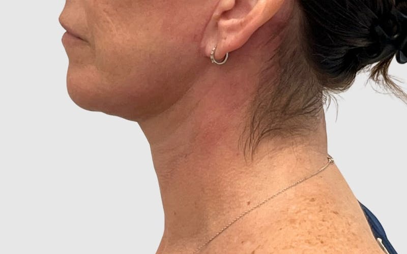Face and Neck Lifts Before & After Gallery - Patient 191405047 - Image 4
