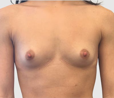 Breast Augmentation Before & After Gallery - Patient 230002 - Image 1