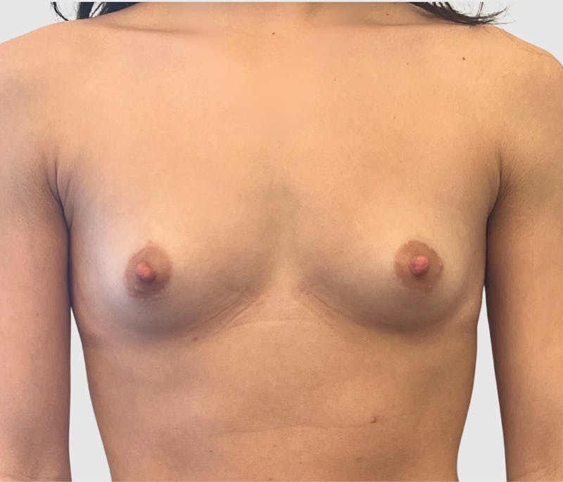 Breast Augmentation Before & After Gallery - Patient 230002 - Image 1