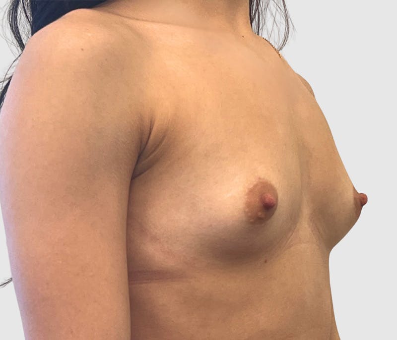 Breast Augmentation Before & After Gallery - Patient 230002 - Image 3