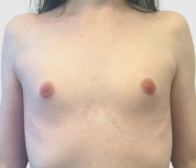 Breast Augmentation Before & After Gallery - Patient 191639433 - Image 1