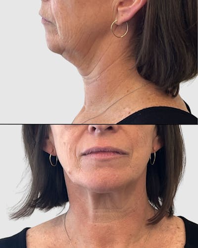 Face and Neck Lifts Before & After Gallery - Patient 191405047 - Image 1
