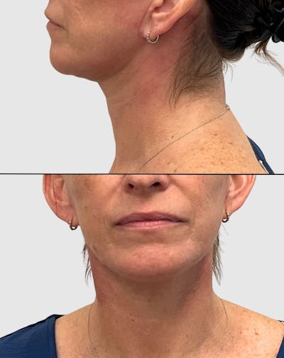 Face and Neck Lifts Before & After Gallery - Patient 191405047 - Image 2