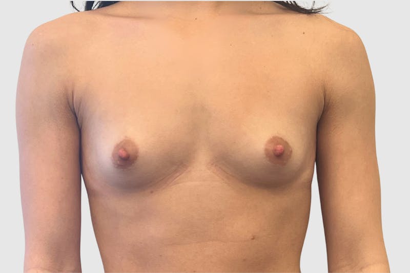Breast Augmentation Before & After Gallery - Patient 230002 - Image 1