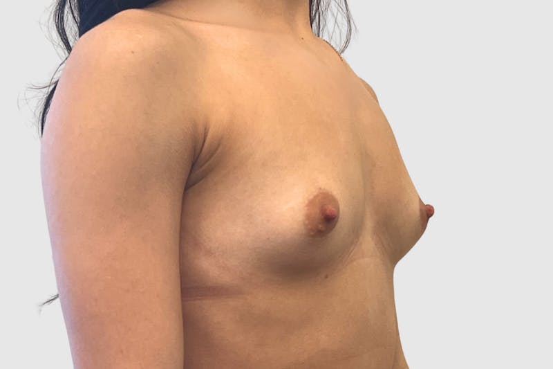 Breast Augmentation Before & After Gallery - Patient 230002 - Image 3