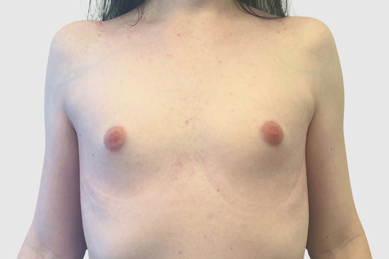 Breast Augmentation Before & After Gallery - Patient 191639433 - Image 1