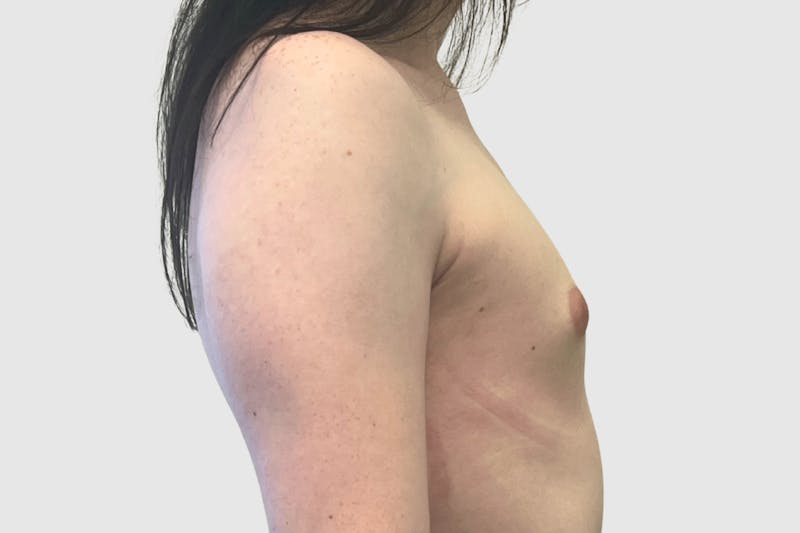 Breast Augmentation Before & After Gallery - Patient 191639433 - Image 3
