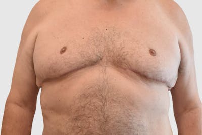 Gynecomastia Before & After Gallery - Patient 199216 - Image 2