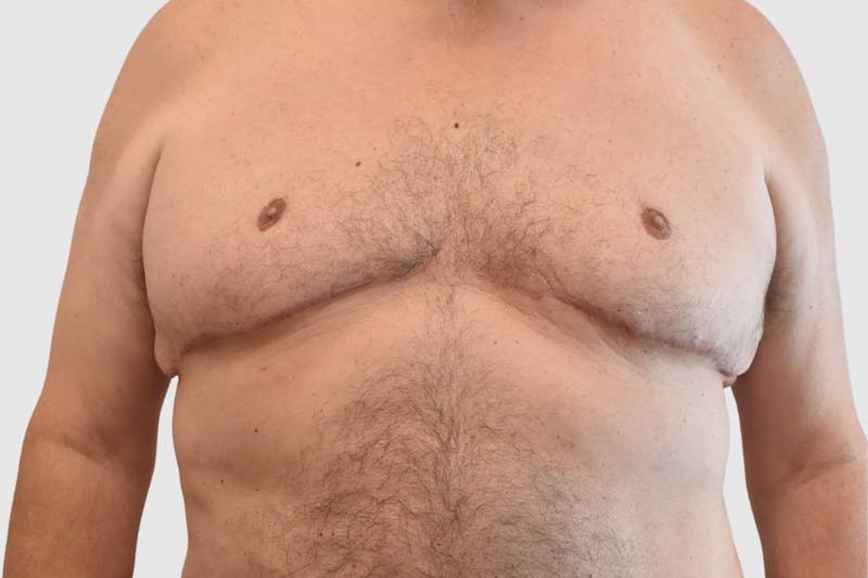 Gynecomastia Before & After Gallery - Patient 199216 - Image 2