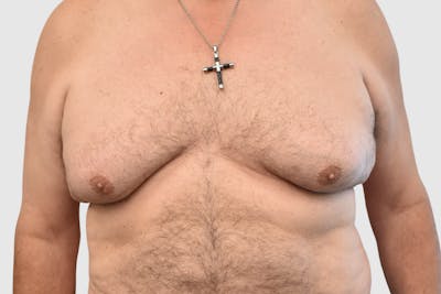 Gynecomastia Before & After Gallery - Patient 199216 - Image 1