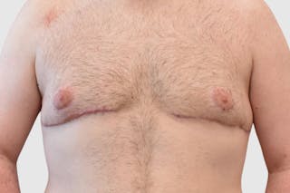Gynecomastia Before & After Gallery - Patient 101416 - Image 2