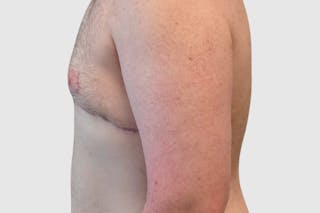 Gynecomastia Before & After Gallery - Patient 101416 - Image 4