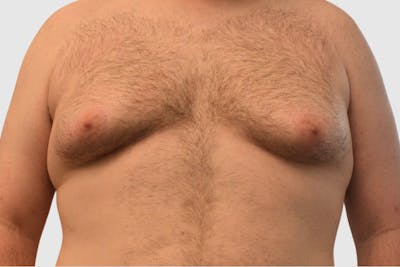 Gynecomastia Before & After Gallery - Patient 101416 - Image 1